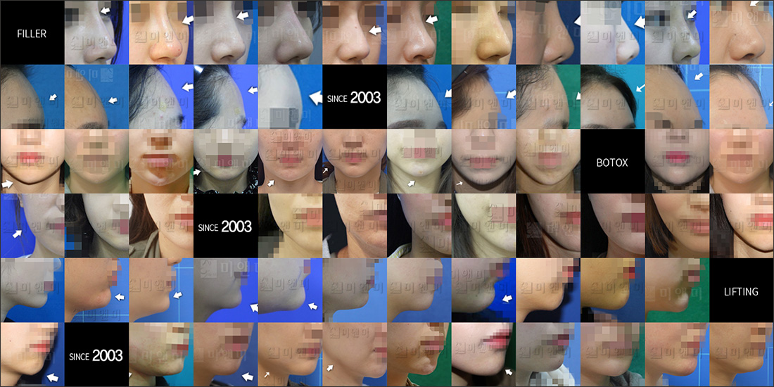 SINCE 2003 MI&MI, 시술후사진모음 대구리쥬란힐러,대구동성로리쥬란힐러