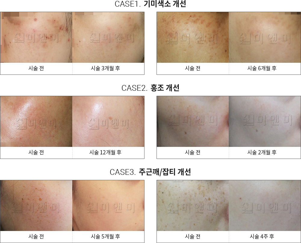 시술전후사진 : 대구피부과-반월당역피부과 자연스럽게 예뻐지는 방법 대구피부과 미앤미