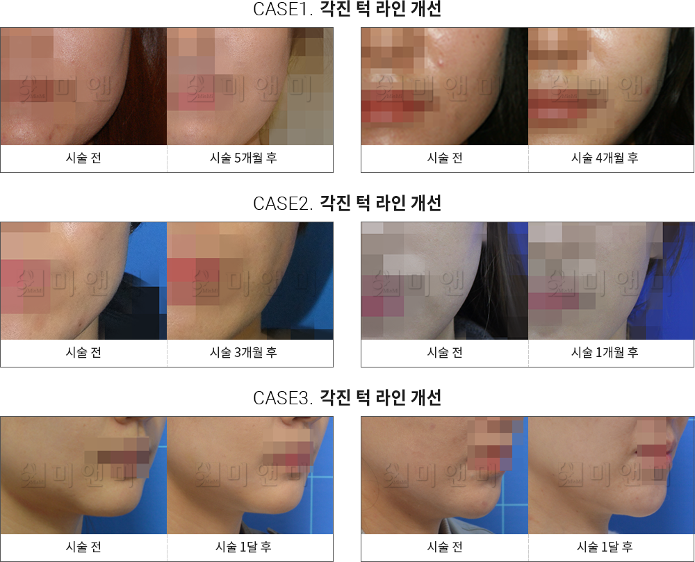 시술전후사진 사각턱 보톡스 : 각진 턱 라인 개선 대구사각턱보톡스, 대구동성로사각턱보톡스