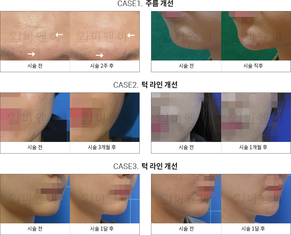 시술전후사진 주름 보톡스 : 주름 개선, 턱 라인 개선 대구주름보톡스, 대구동성로주름보톡스