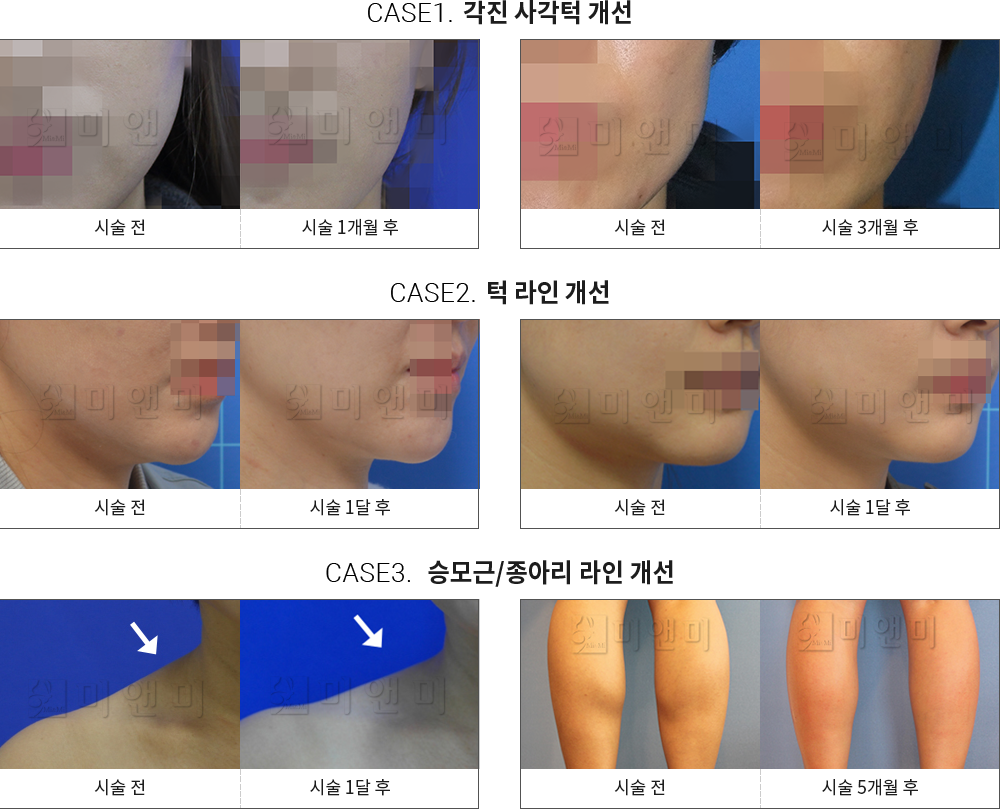 시술전후사진 승모근 보톡스 : 각진 사각턱 개선,턱 라인 개선,승모근/종아리 라인 개선 대구승모근보톡스, 대구동성로승모근보톡스