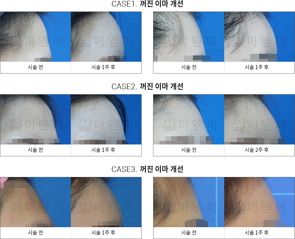 시술전후사진 이마필러 : 무턱개선 대구이마필러, 대구동성로이마필러