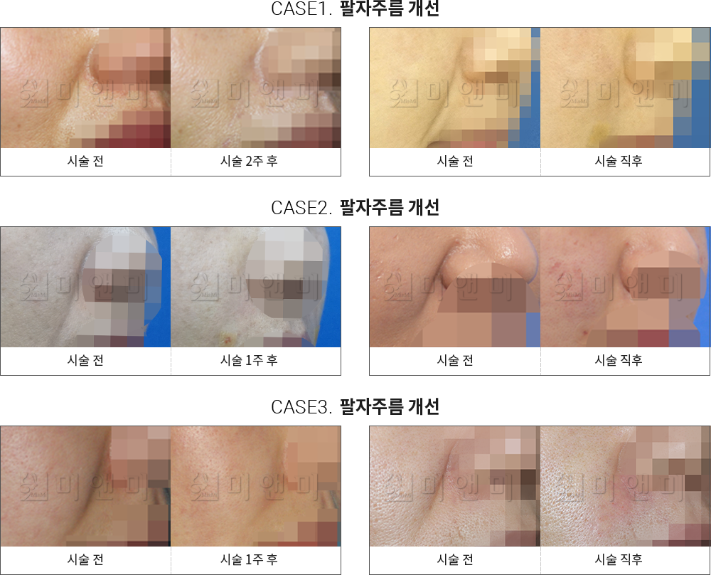 시술전후사진 팔자필러 : 팔자주름 개선 대구팔자주름필러, 대구동성로팔자주름필러